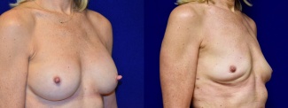 Right 3/4 View - Breast Implant Removal