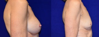 Right Profile View - Breast Implant Removal