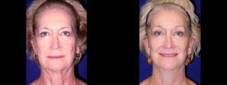 Frontal View - Facelift with Browlift