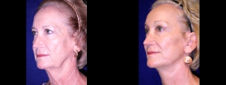 Left 3/4 View - Facelift with Browlift