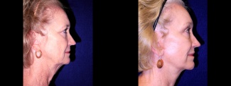 Right Profile View - Facelift with Browlift