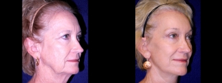 Right 3/4 View - Facelift with Browlift