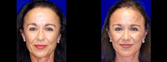 Frontal View - Lower Facelift