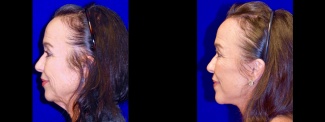 Left Profile View - Lower Facelift