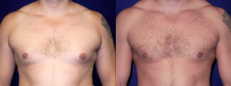 Frontal View - Gynecomastia