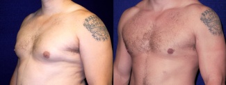 Left 3/4 View - Gynecomastia