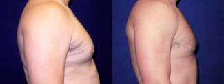 Right Profile View - Gynecomastia