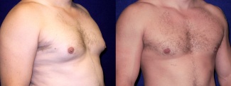 Right 3/4 View - Gynecomastia