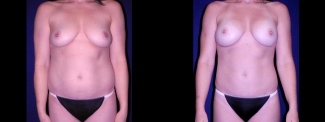 Frontal View - Tummy Tuck with Breast Augmentation