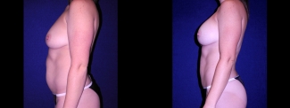 Left Profile View - Tummy Tuck with Breast Augmentation