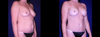 Right 3/4 View - Tummy Tuck with Breast Augmentation