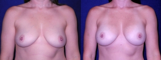 Frontal View - Breast Augmentation