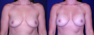 Frontal View - Breast Augmentation