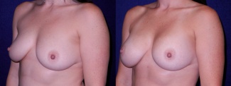 Left 3/4 View - Breast Augmentation