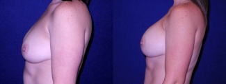 Left Profile View - Breast Augmentation