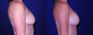 Right Profile View - Breast Augmentation