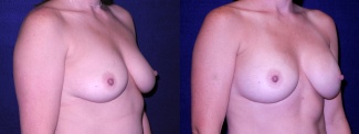 Right 3/4 View - Breast Augmentation