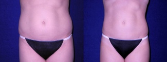 Frontal View - Tummy Tuck