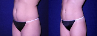 Left 3/4 View - Tummy Tuck