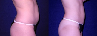 Right Profile View - Tummy Tuck