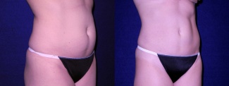 Right 3/4 View - Tummy Tuck