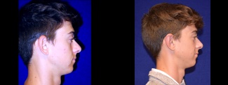 Right Profile View - Otoplasty