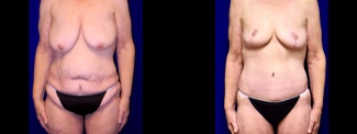 Frontal View - Extended Tummy Tuck with Breast Reduction
