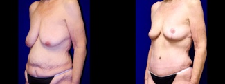 Left 3/4 View - Extended Tummy Tuck with Breast Reduction