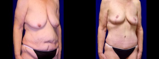 Right 3/4 View - Extended Tummy Tuck with Breast Reduction