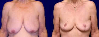 Frontal View - Breast Reduction