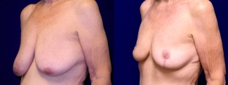 Left 3/4 View - Breast Reduction