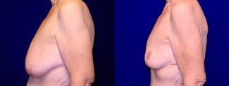 Left Profile View - Breast Reduction