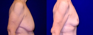 Right Profile View - Breast Reduction