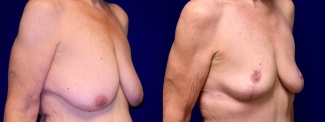 Right 3/4 View - Breast Reduction