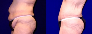Left Profile View - Extended Tummy Tuck 