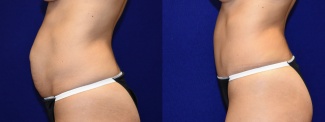 Left Profile View - Tummy Tuck