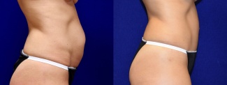 Right Profile View - Tummy Tuck