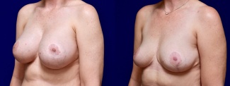 Left 3/4 View - Breast Implant Removal