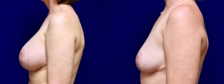 Left Profile View - Breast Implant Removal