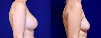 Right Profile View - Breast Implant Removal