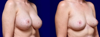 Right 3/4 View - Breast Implant Removal