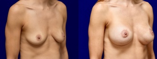 Right 3/4 View - Breast Augmentation