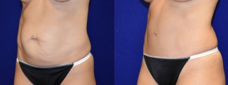 Left 3/4 View - Tummy Tuck