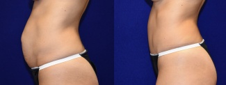 Left Profile View - Tummy Tuck