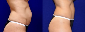 Right Profile View - Tummy Tuck