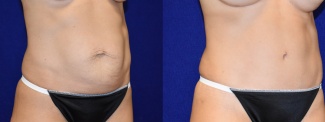 Right 3/4 View - Tummy Tuck