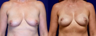 Frontal View - Breast Lift