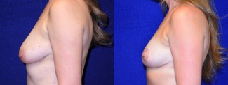 Left Profile View - Breast Lift