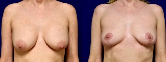 Frontal View - Breast Implant Removal with Breast Lift