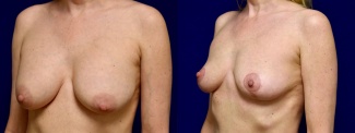Left 3/4 View - Breast Implant Removal with Breast Lift